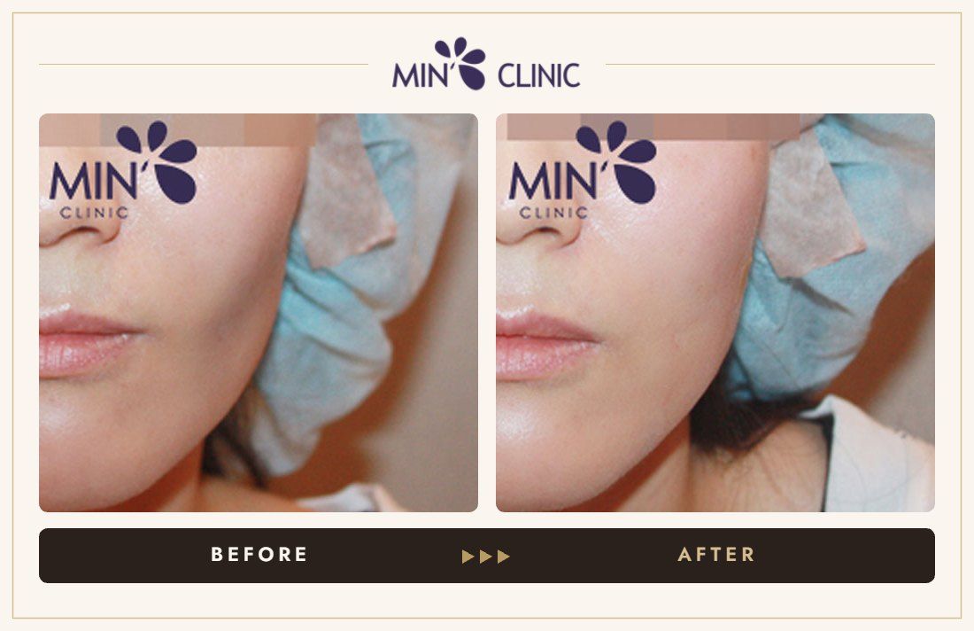 Cheek filler before and after, case 2 – MIN Clinic Seoul