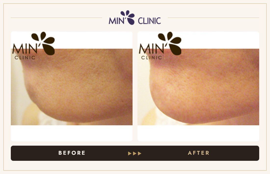 Chin filler before and after, case 3 – MIN Clinic Seoul