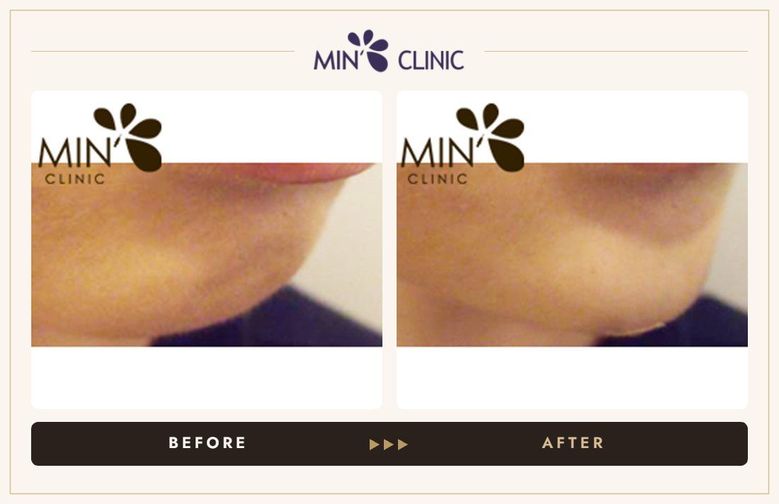 Chin filler before and after, case 4 – MIN Clinic Seoul