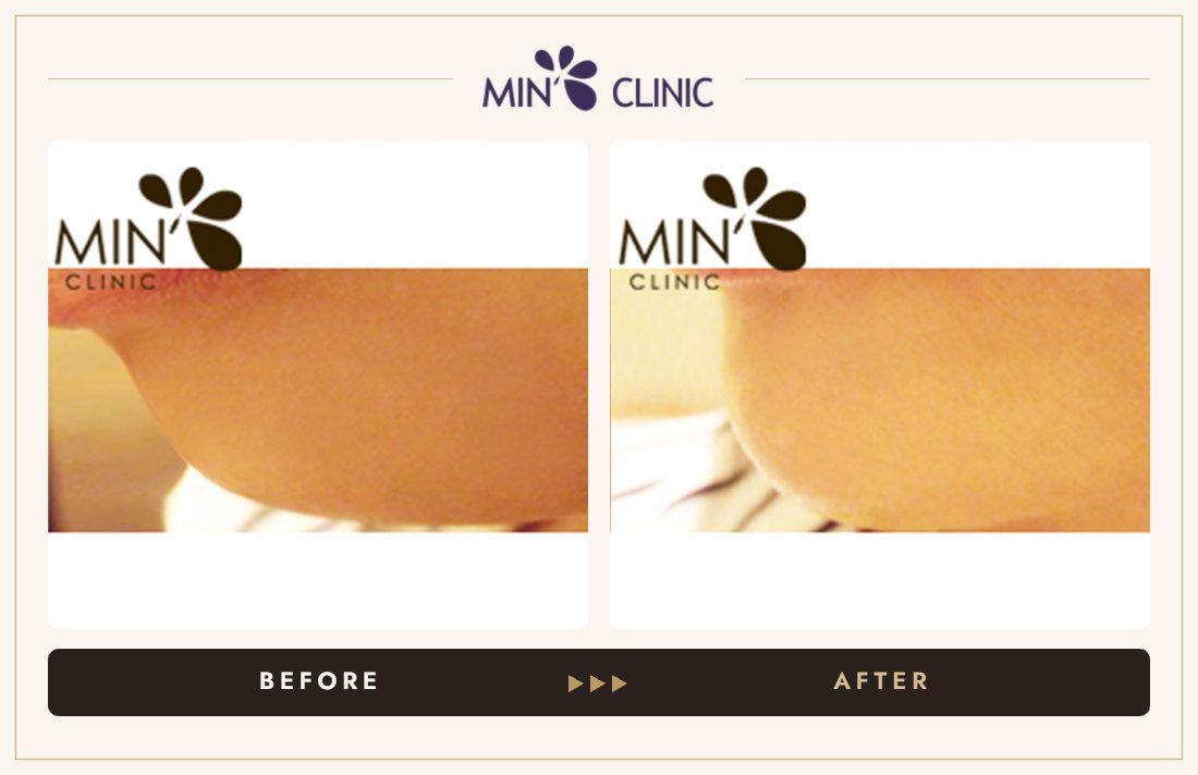 Chin filler before and after, case 5 – MIN Clinic Seoul