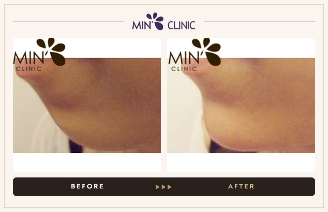 Chin filler before and after, case 6 – MIN Clinic Seoul