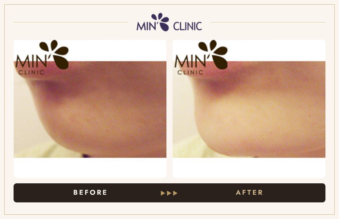 Chin filler before and after, case 7 – MIN Clinic Seoul