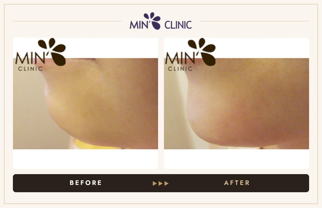 Chin filler before and after, case 8 – MIN Clinic Seoul