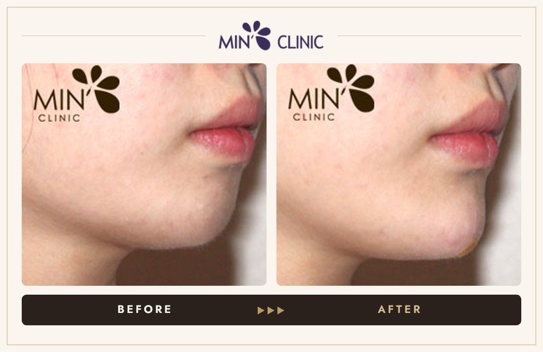 Chin filler before and after, case 9 – MIN Clinic Seoul