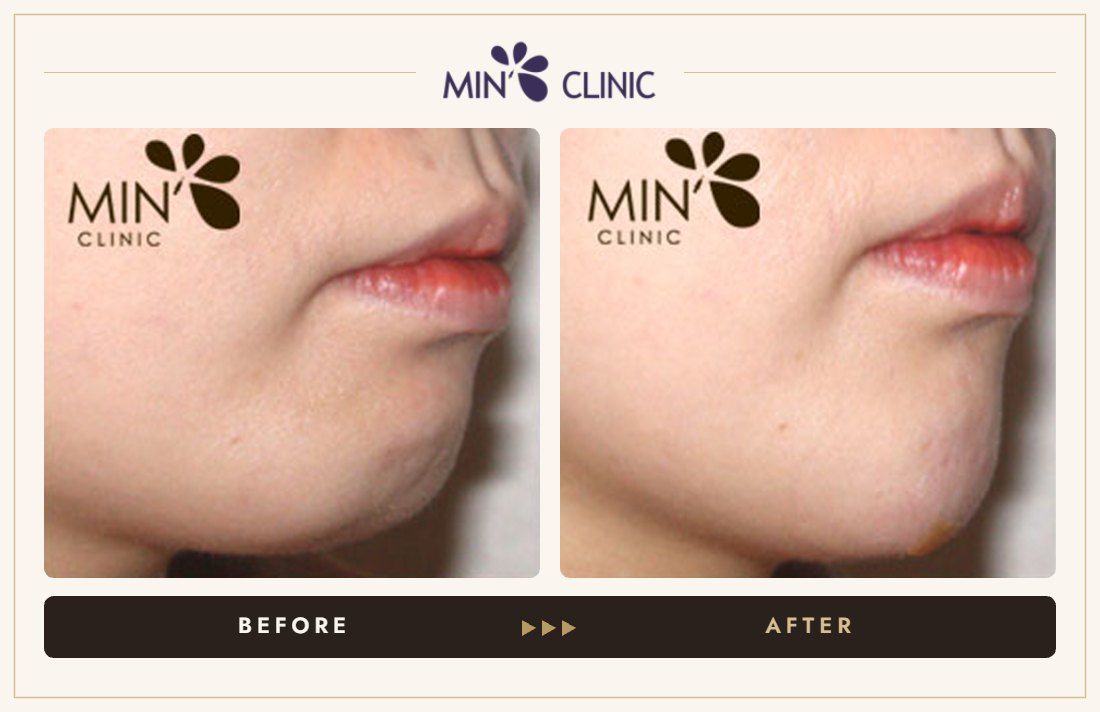 Chin filler before and after, case 10 – MIN Clinic Seoul
