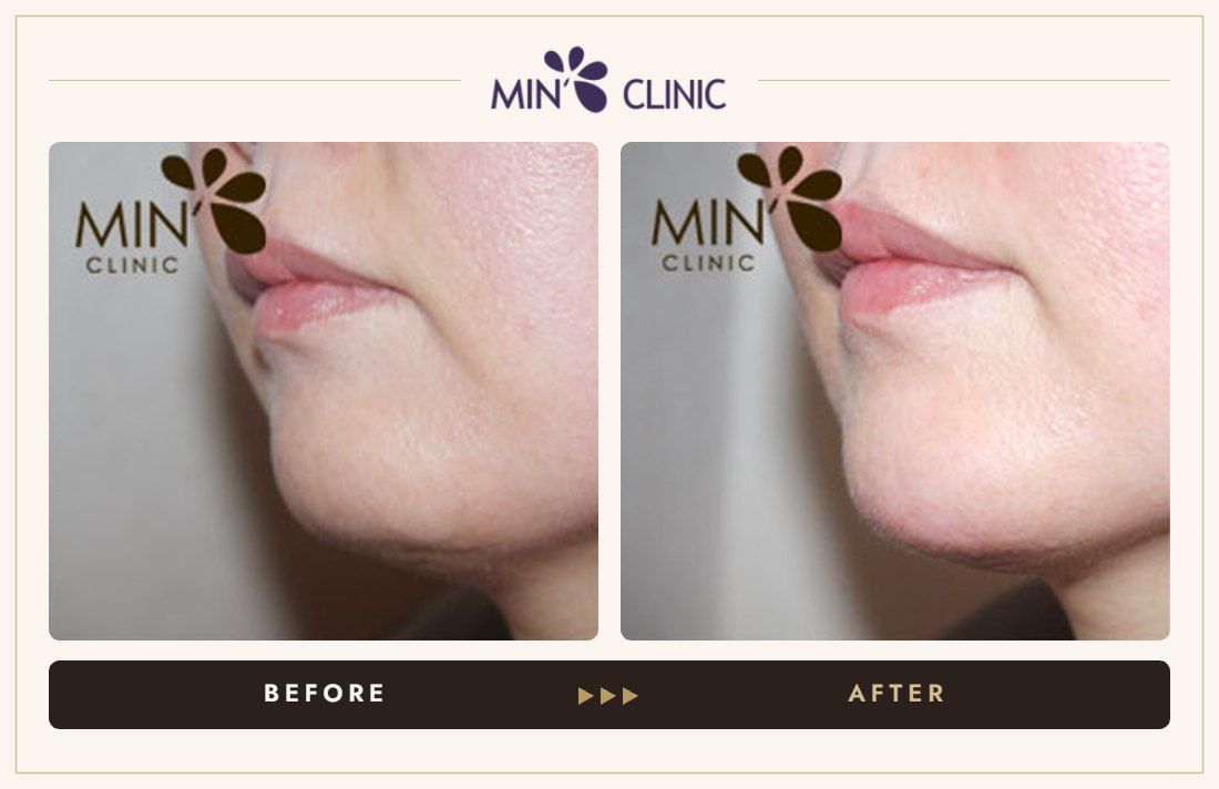 Chin filler before and after, case 11 – MIN Clinic Seoul