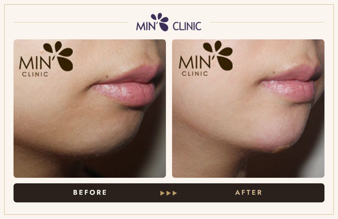 Chin filler before and after, case 12 – MIN Clinic Seoul