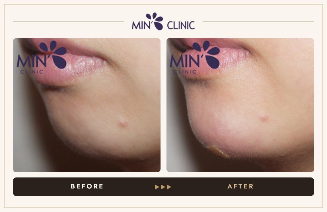 Chin filler before and after, case 13 – MIN Clinic Seoul