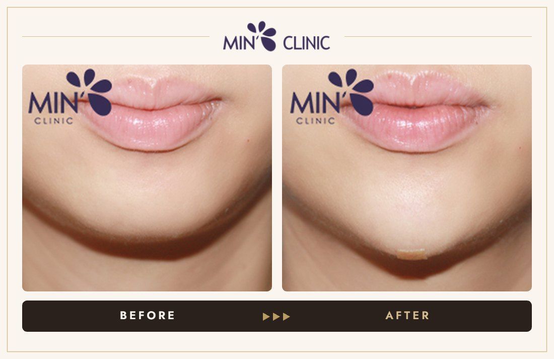 Chin filler before and after, case 14 – MIN Clinic Seoul