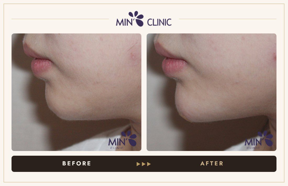 Chin filler before and after, case 15 – MIN Clinic Seoul