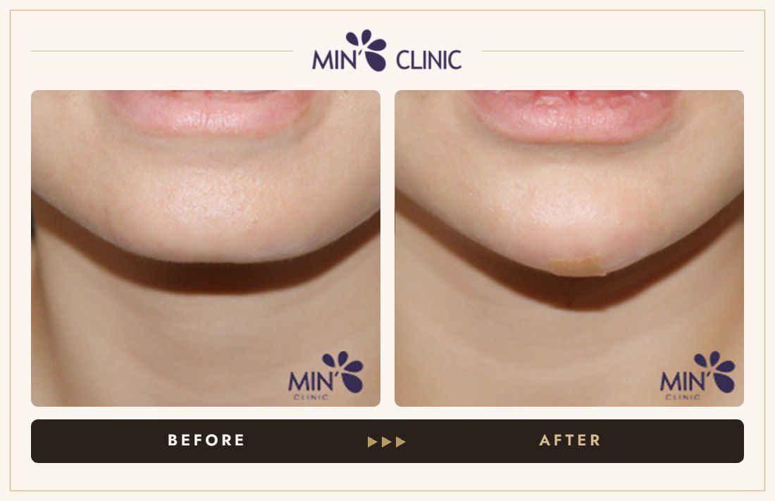 Chin filler before and after, case 16 – MIN Clinic Seoul
