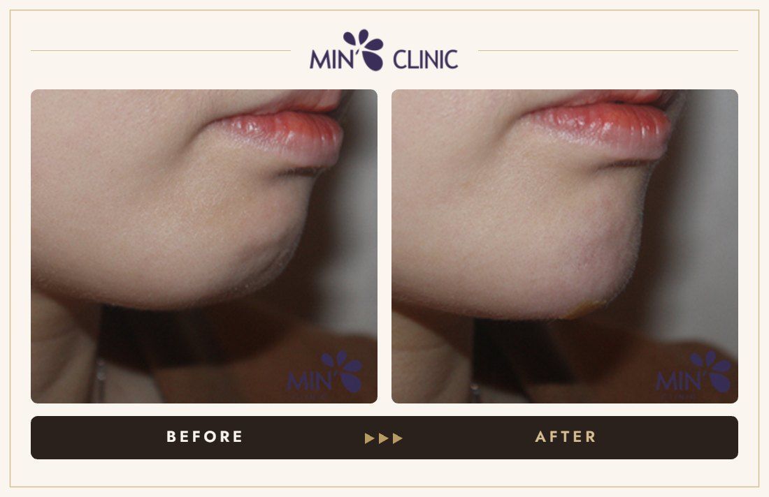 Chin filler before and after, case 17 – MIN Clinic Seoul