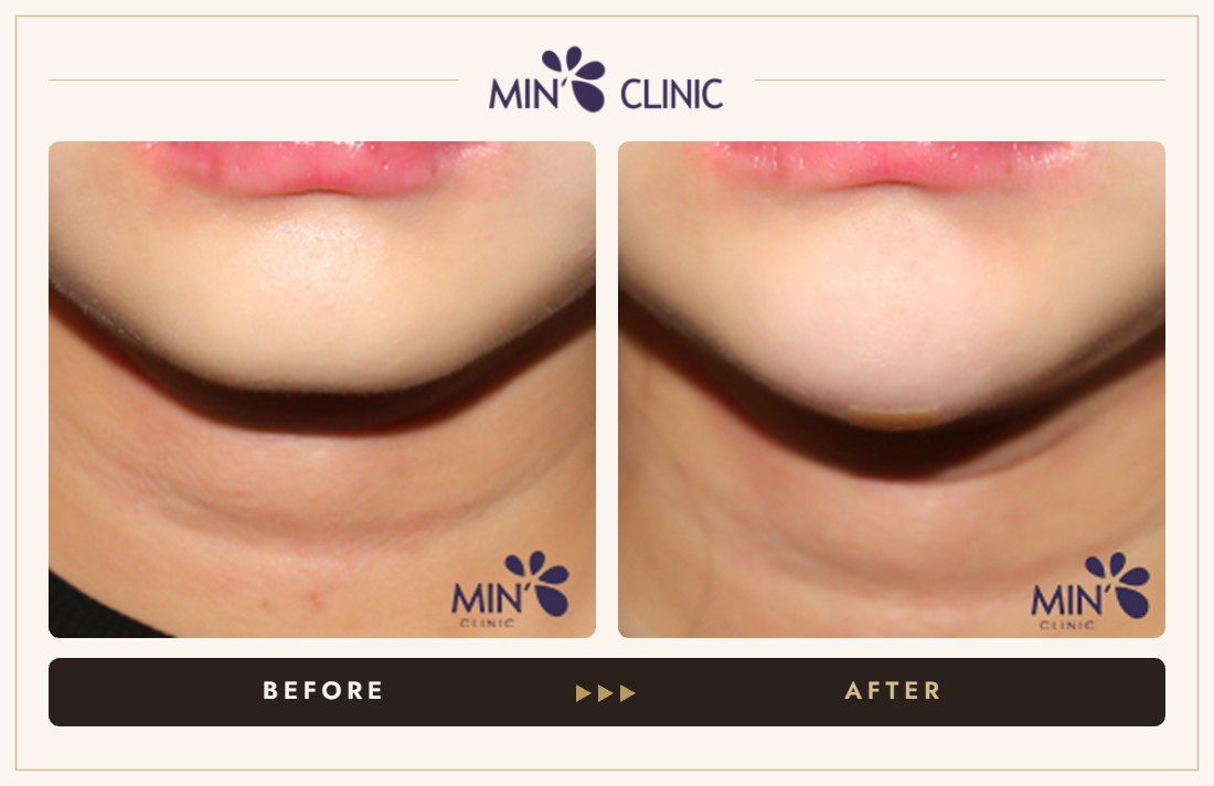 Chin filler before and after, case 18 – MIN Clinic Seoul