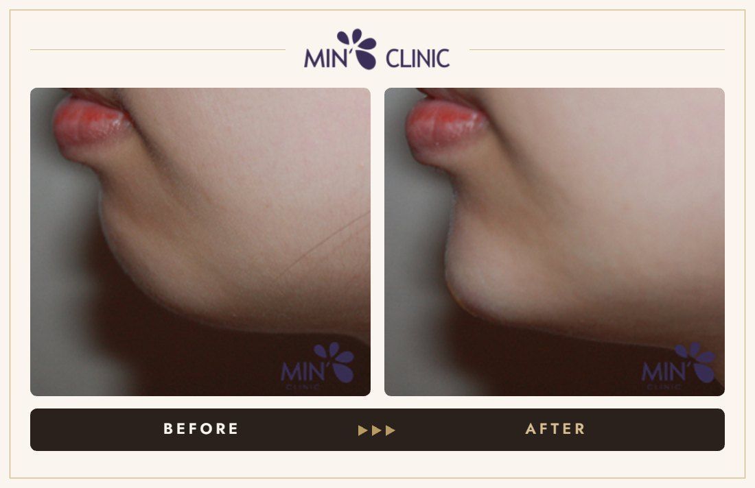 Chin filler before and after, case 19 – MIN Clinic Seoul