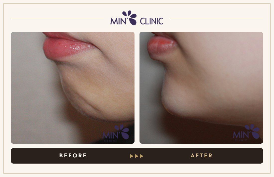 Chin filler before and after, case 20 – MIN Clinic Seoul