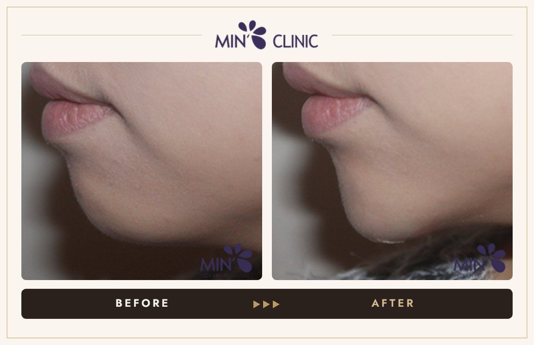 Chin filler before and after, case 21 – MIN Clinic Seoul