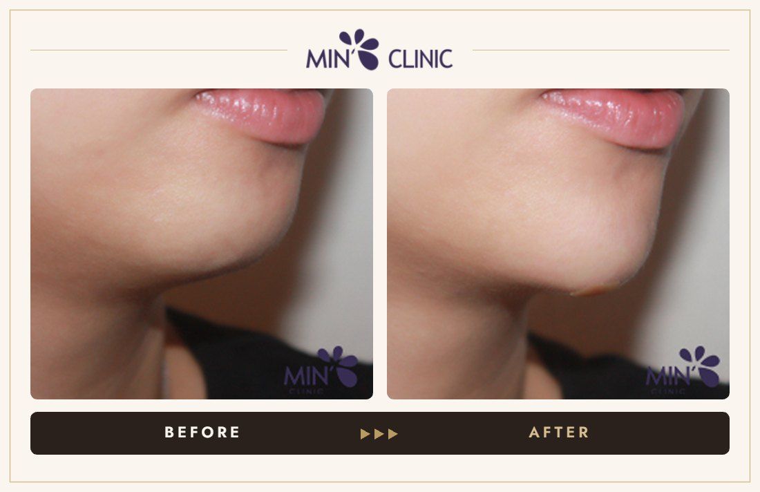 Chin filler before and after, case 22 – MIN Clinic Seoul
