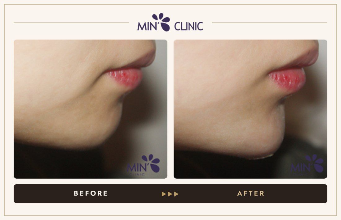 Chin filler before and after, case 23 – MIN Clinic Seoul