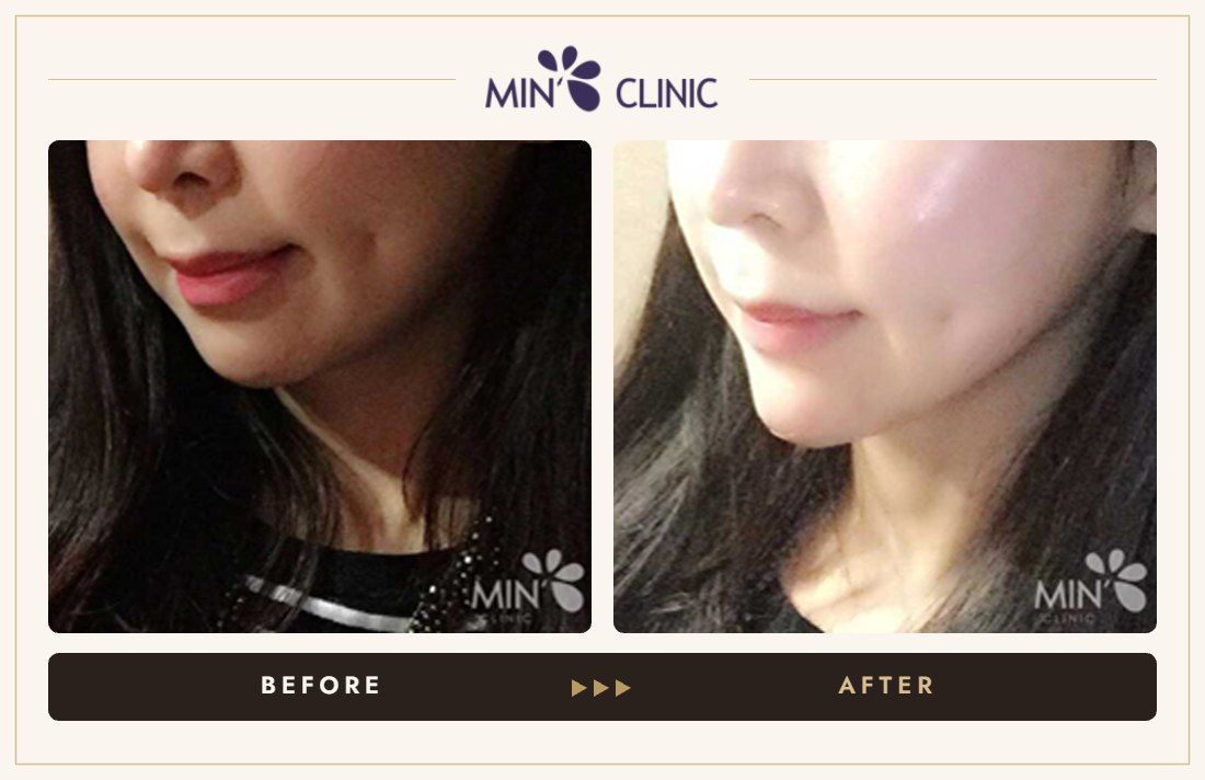 Chin filler + V-line Quick Slim before and after, case 1 – MIN Clinic Seoul