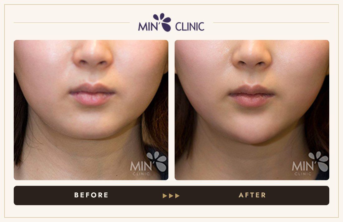 Chin filler before and after, case 24 – MIN Clinic Seoul