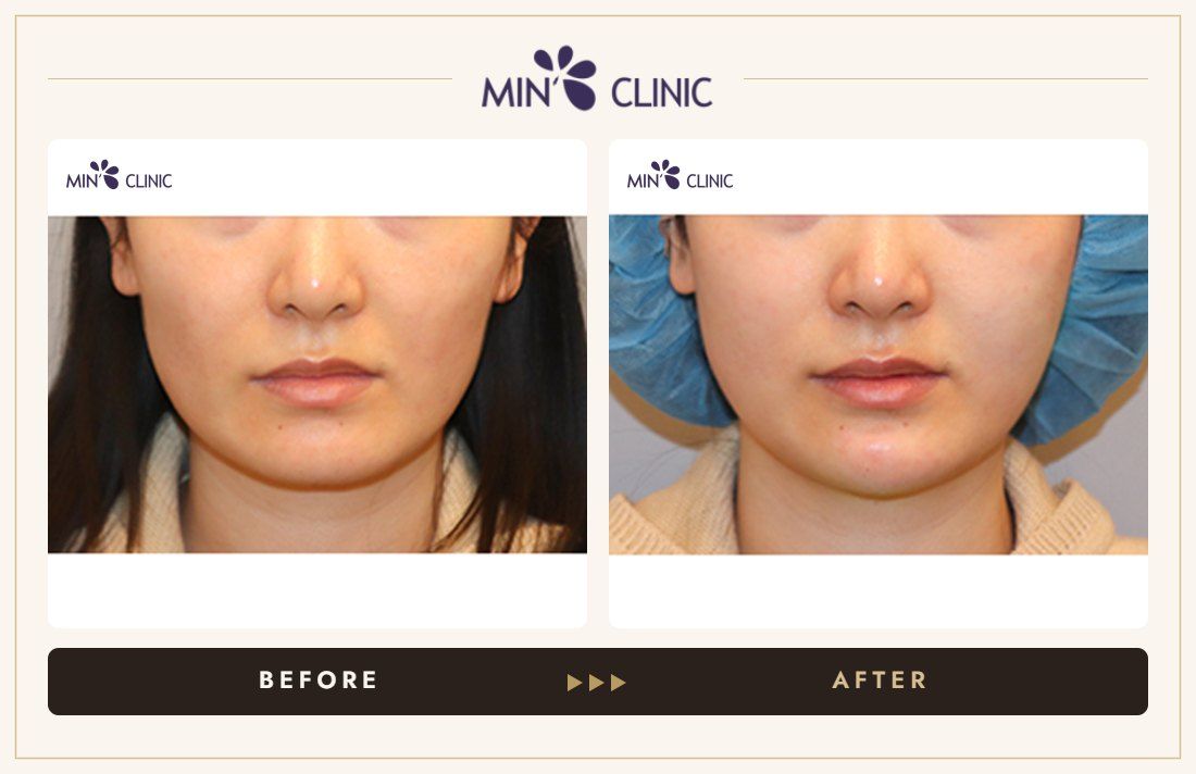 Chin + cheek filler before and after, case 1 – MIN Clinic Seoul