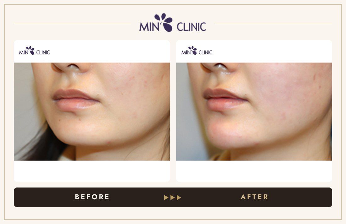 Chin filler before and after, case 25 – MIN Clinic Seoul