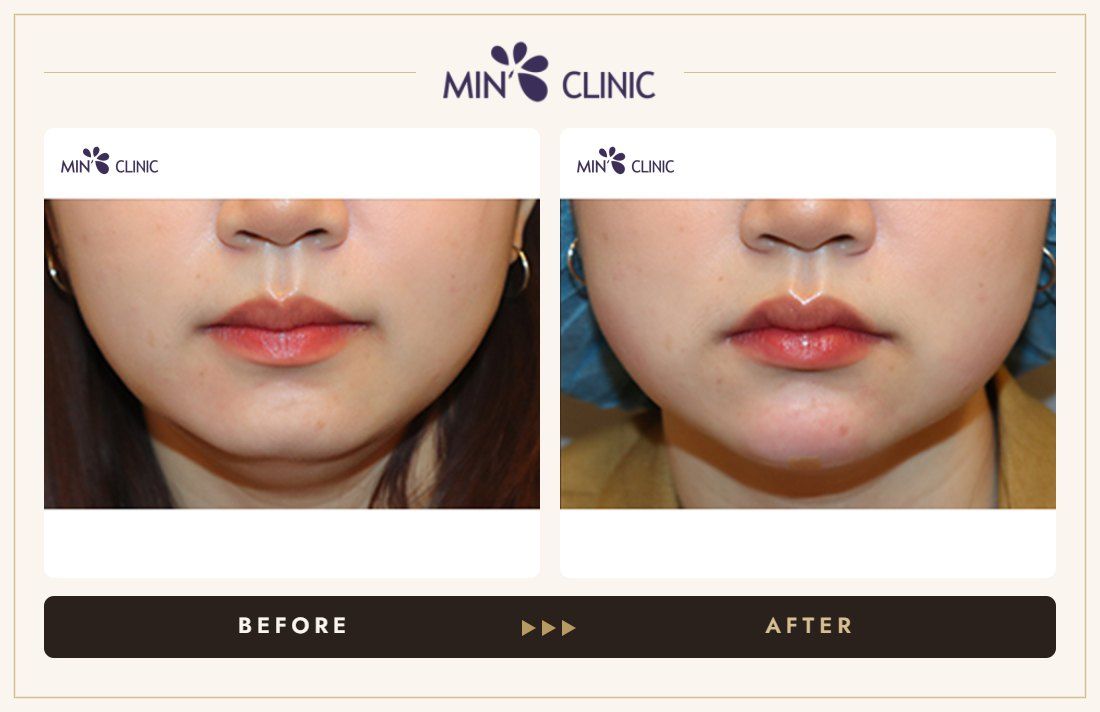 Chin filler before and after, case 26 – MIN Clinic Seoul