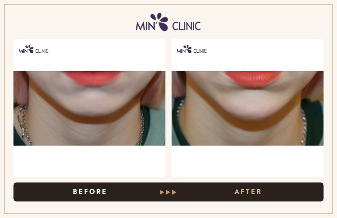 Chin filler before and after, case 27 – MIN Clinic Seoul