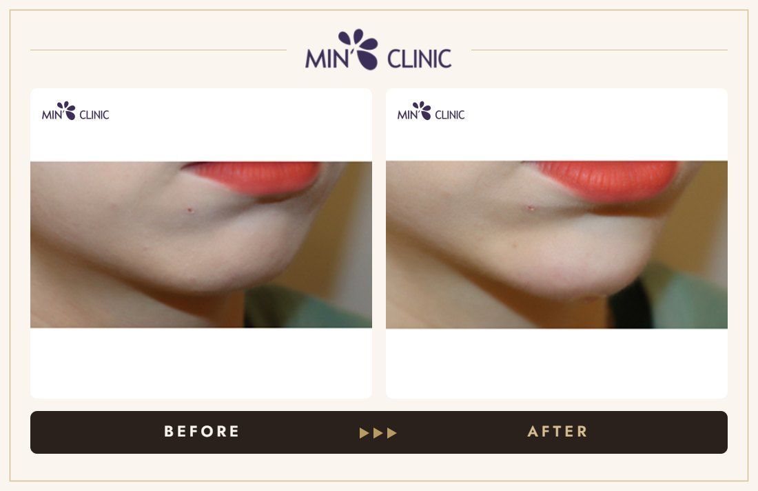 Chin filler before and after, case 28 – MIN Clinic Seoul