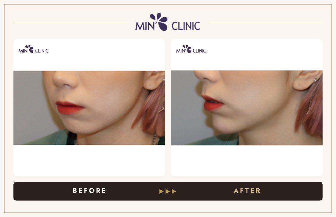 Chin filler before and after, case 29 – MIN Clinic Seoul