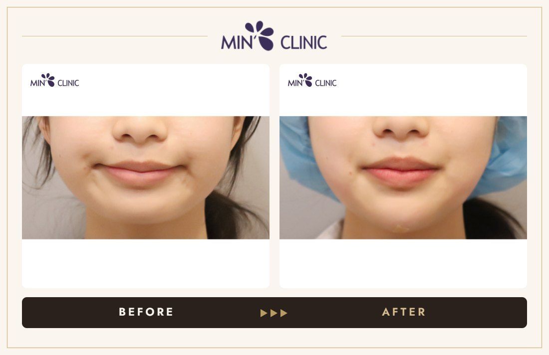 Chin filler before and after, case 30 – MIN Clinic Seoul