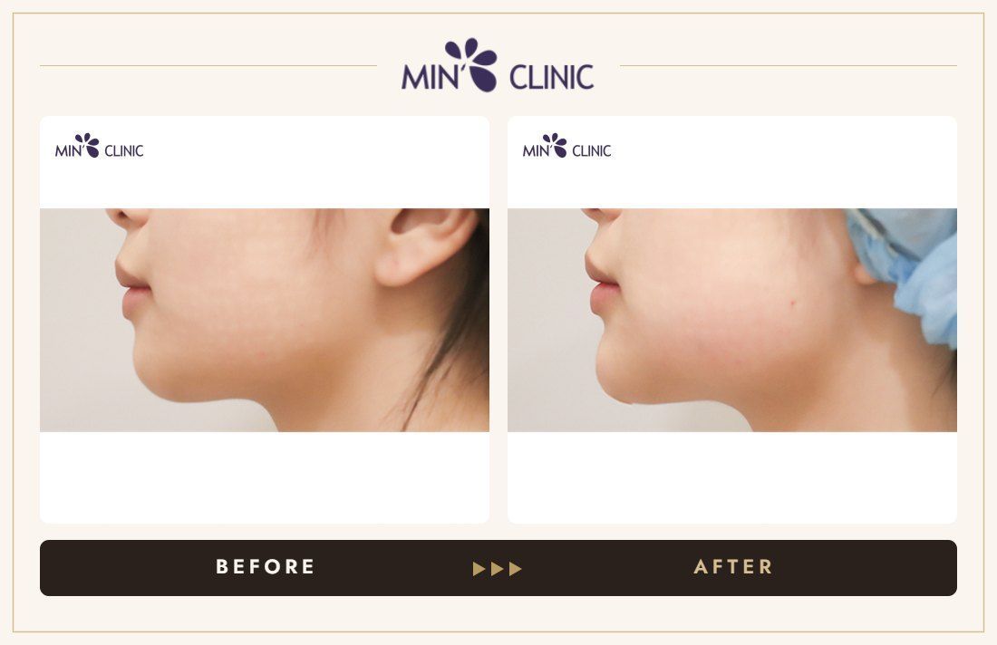 Chin filler before and after, case 31 – MIN Clinic Seoul