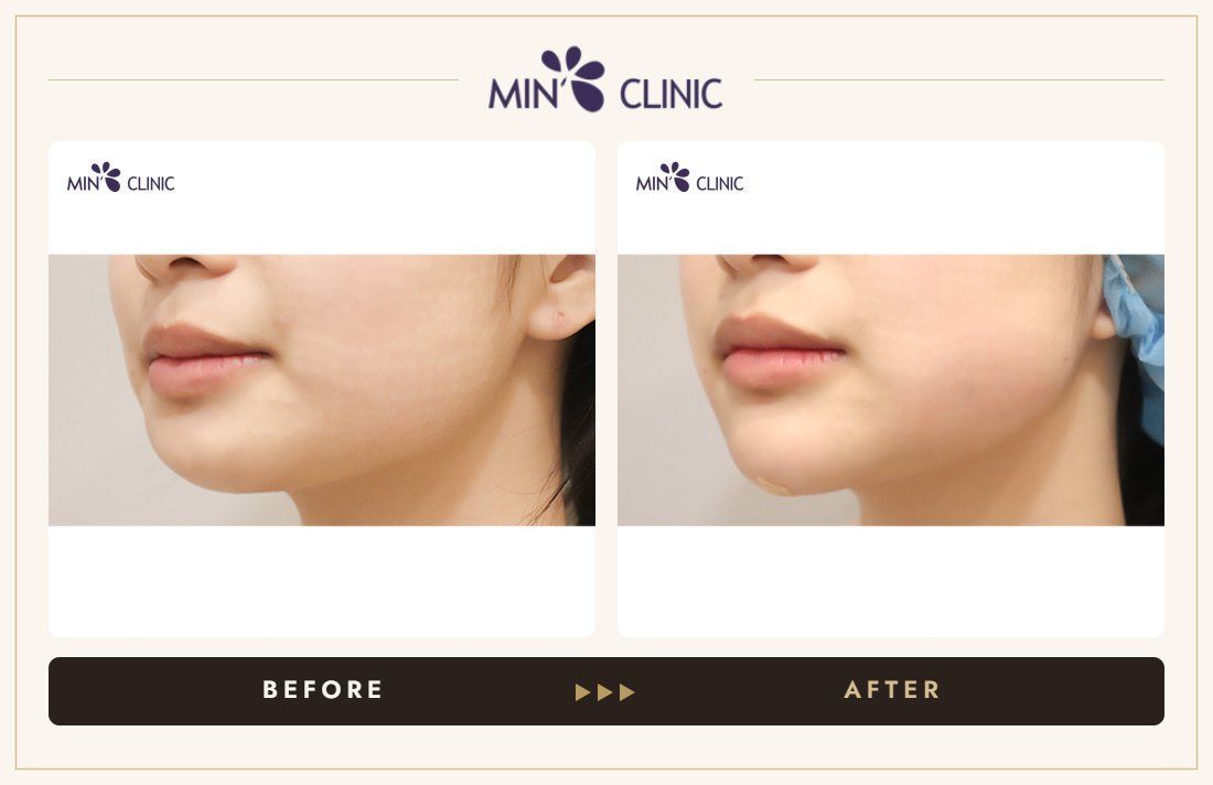 Chin filler before and after, case 32 – MIN Clinic Seoul