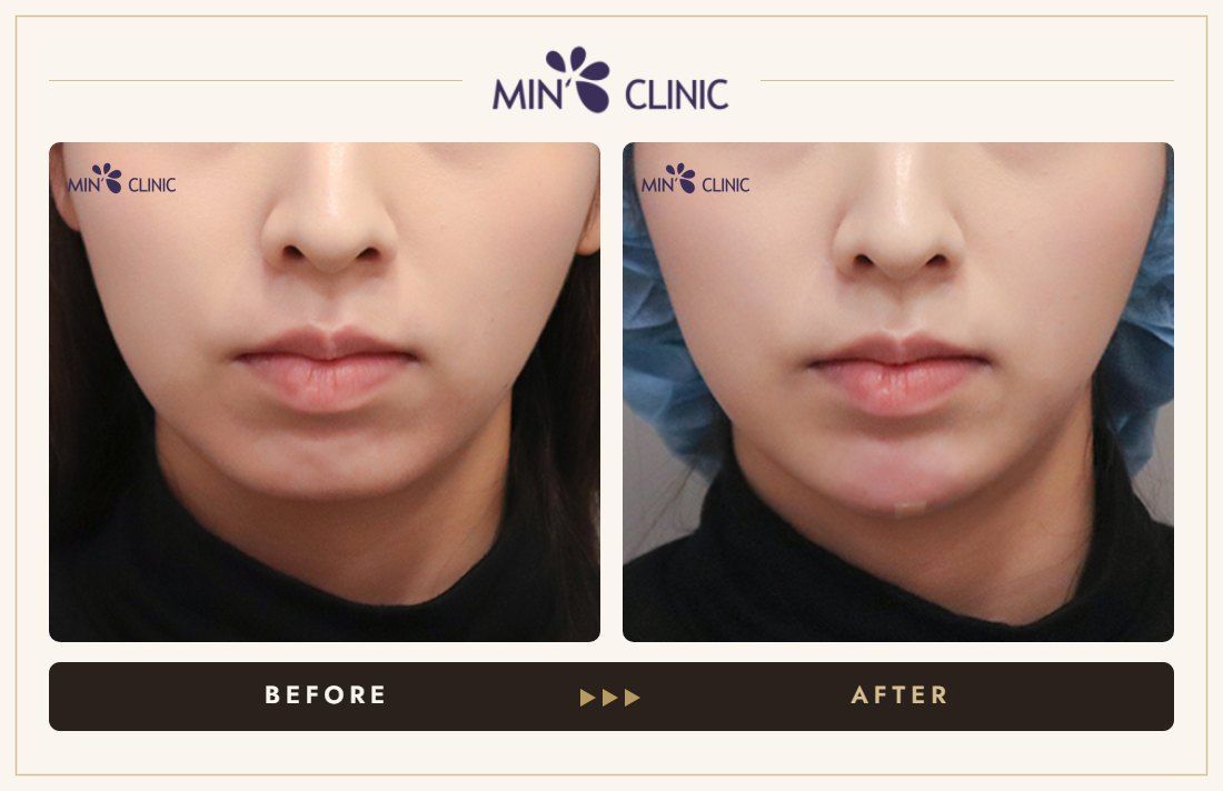 Chin filler before and after, case 33 – MIN Clinic Seoul