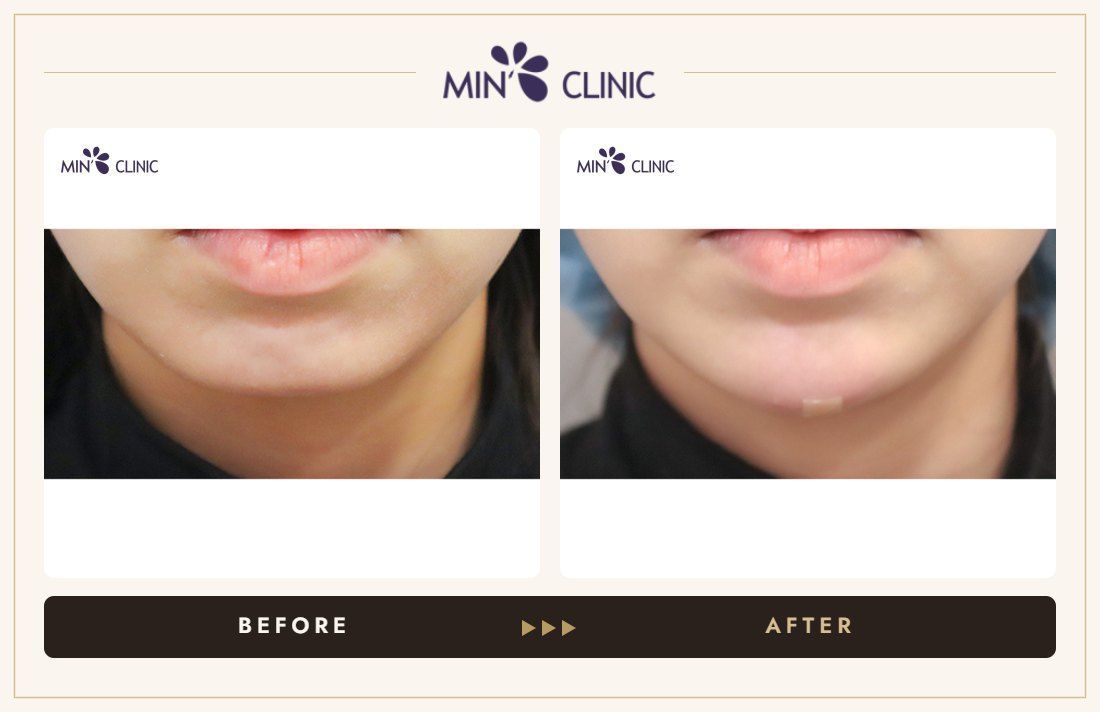 Chin filler before and after, case 34 – MIN Clinic Seoul