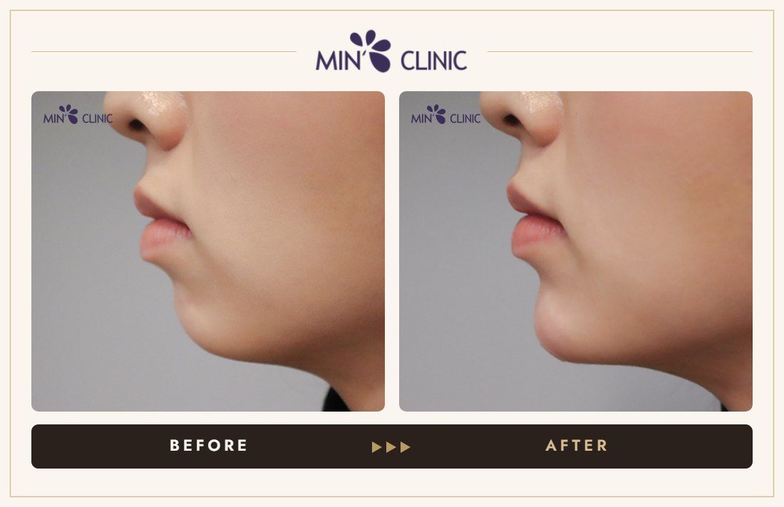 Chin filler before and after, case 35 – MIN Clinic Seoul