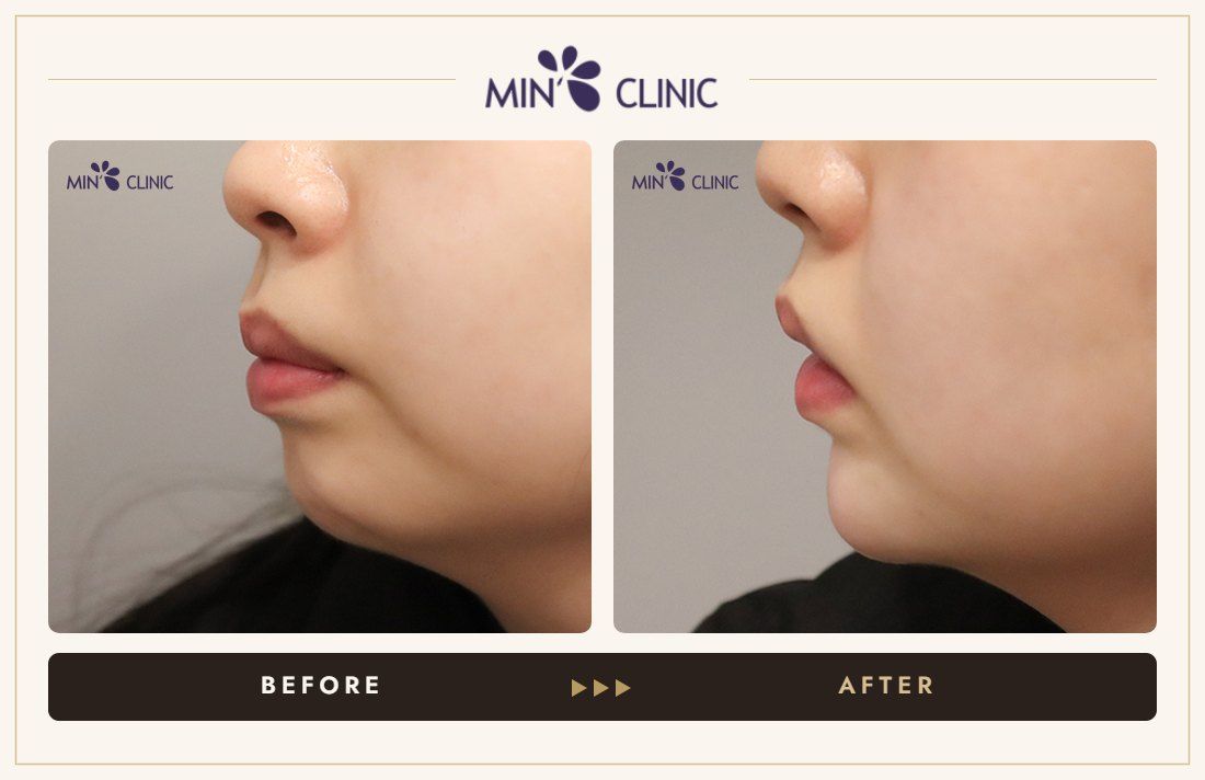 Chin filler before and after, case 36 – MIN Clinic Seoul