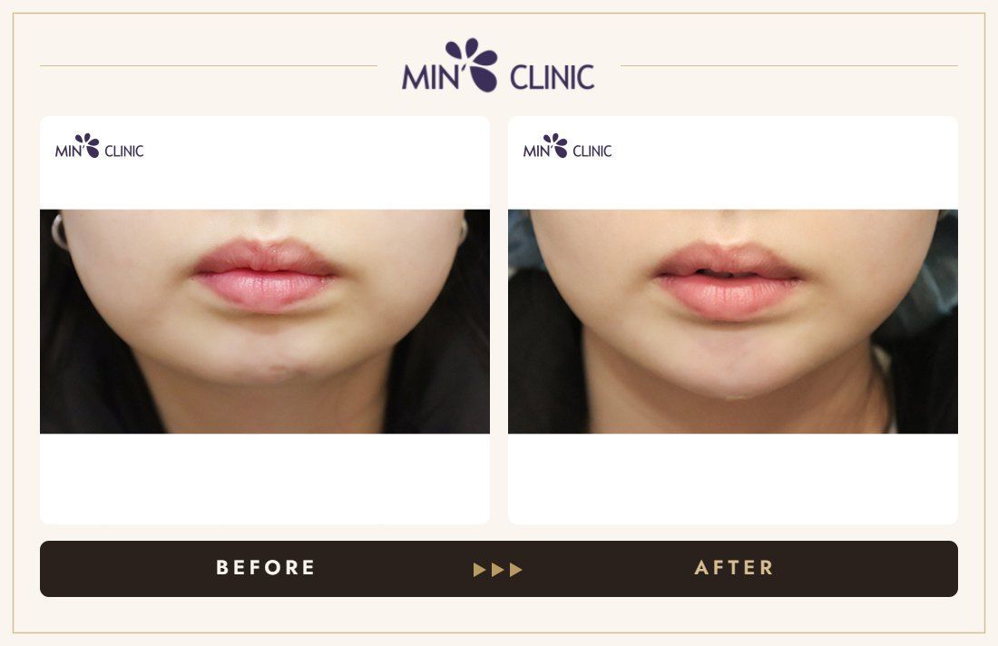 Chin filler before and after, case 37 – MIN Clinic Seoul