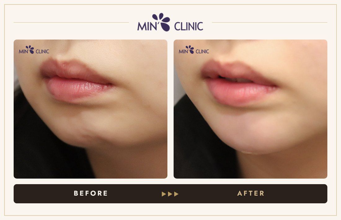 Chin filler before and after, case 38 – MIN Clinic Seoul