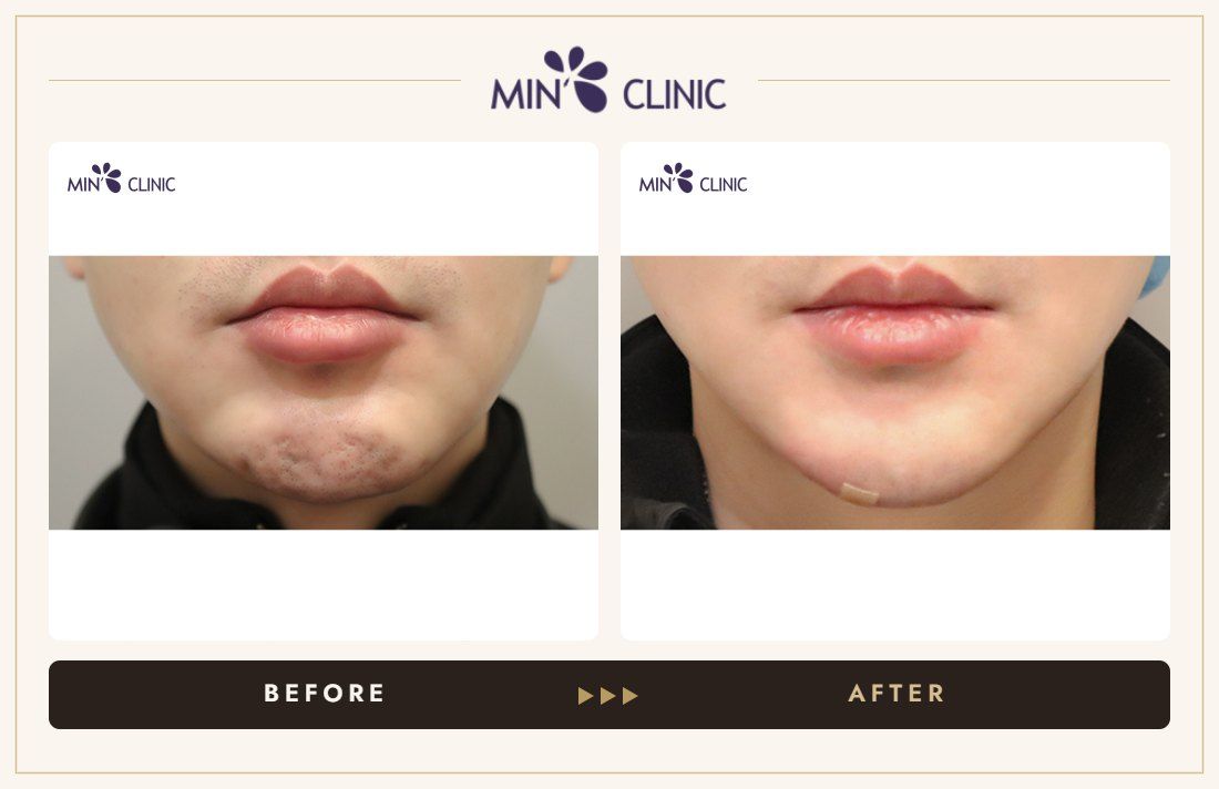 Chin filler before and after, case 39 – MIN Clinic Seoul