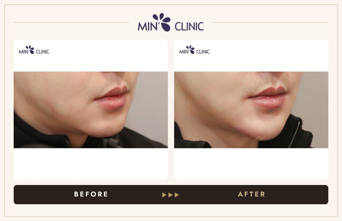 Chin filler before and after, case 40 – MIN Clinic Seoul