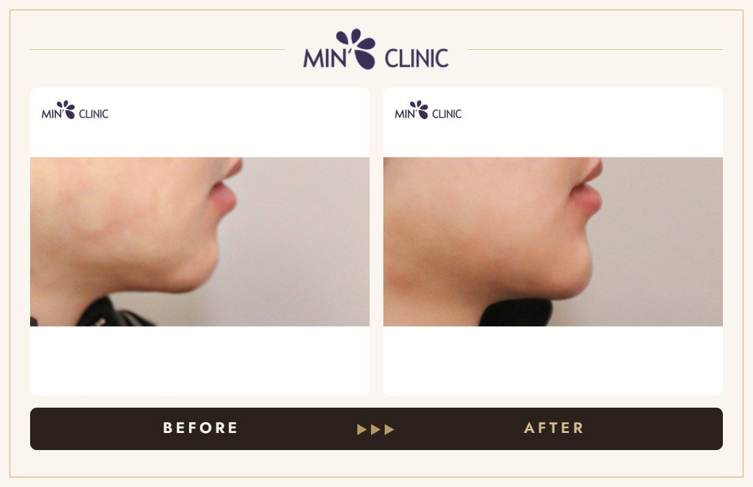 Chin filler before and after, case 41 – MIN Clinic Seoul