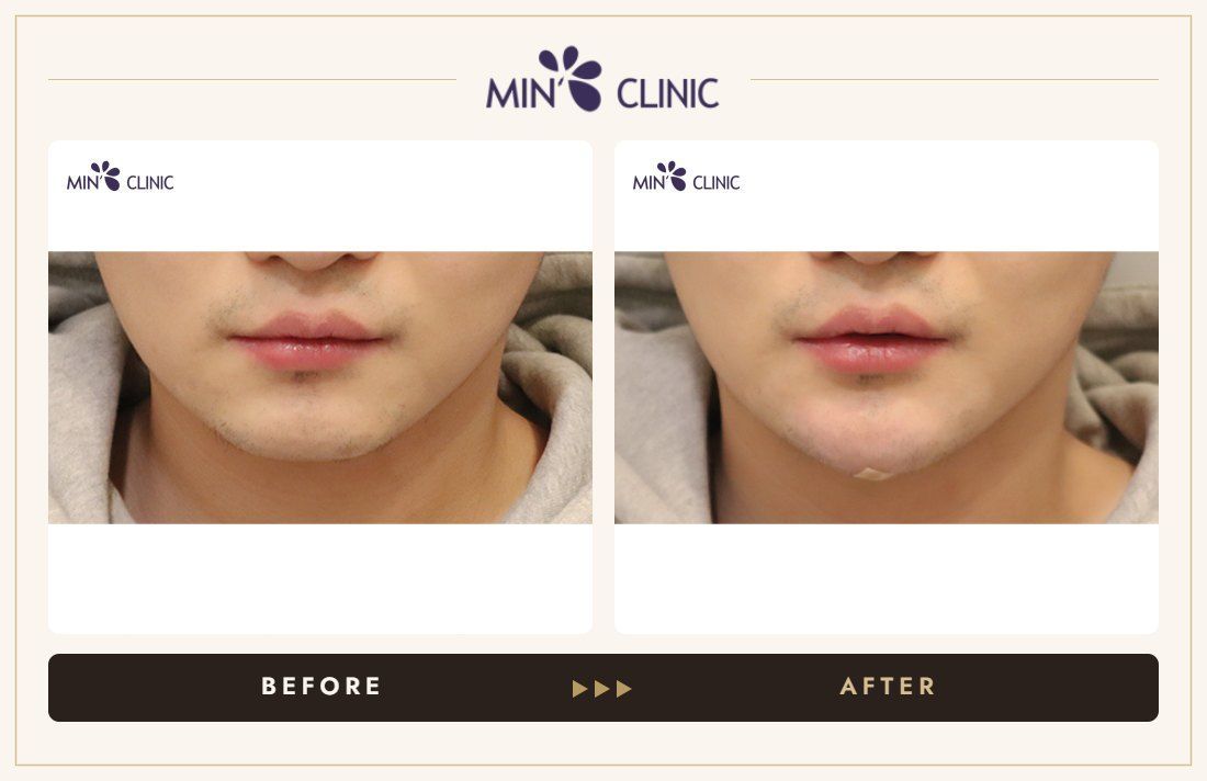 Chin filler before and after, case 42 – MIN Clinic Seoul