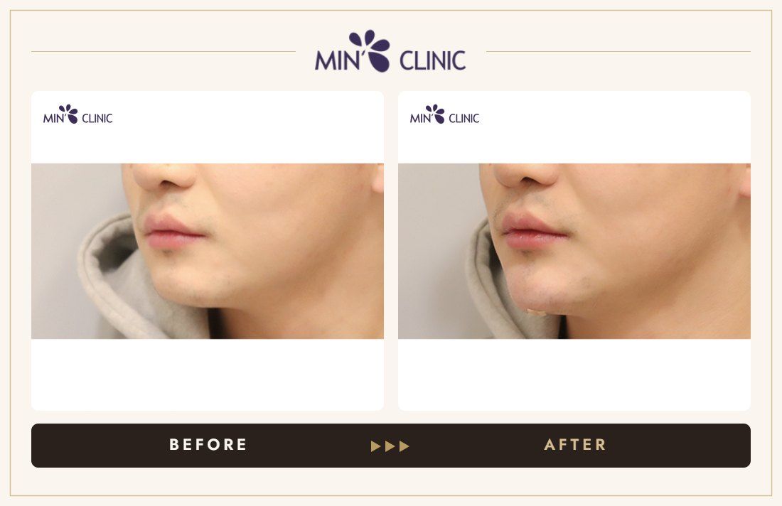 Chin filler before and after, case 43 – MIN Clinic Seoul