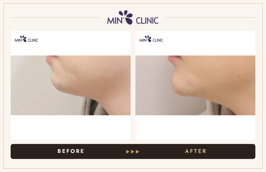 Chin filler before and after, case 44 – MIN Clinic Seoul