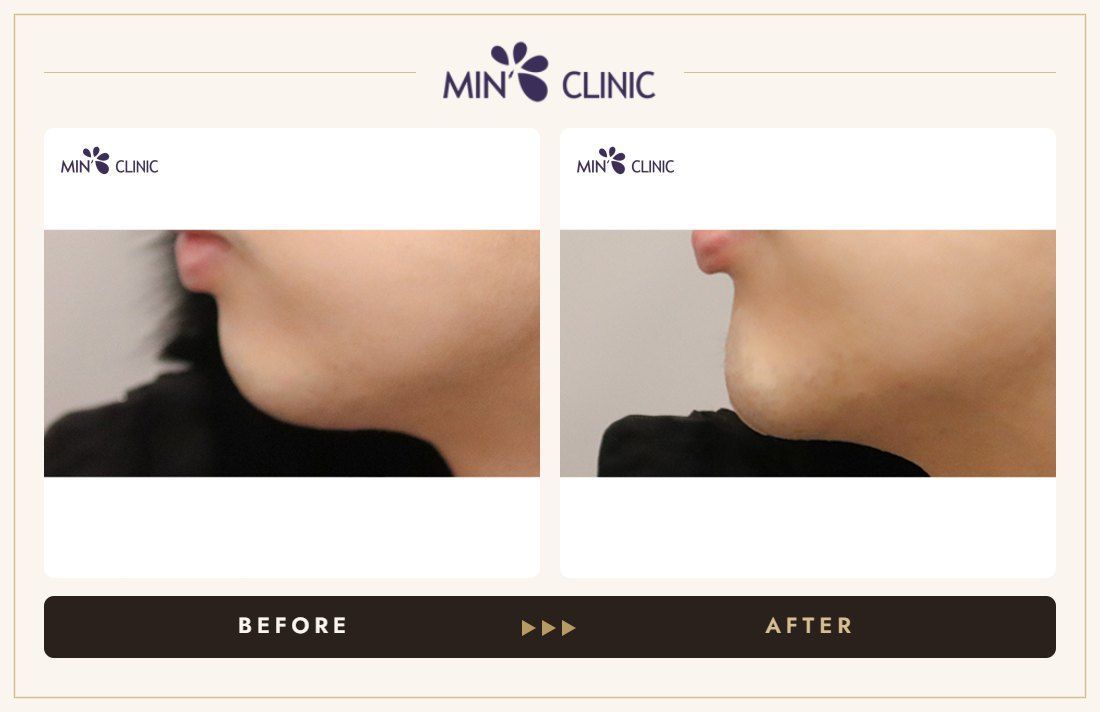 Chin filler before and after – MIN Clinic Gangnam, Seoul