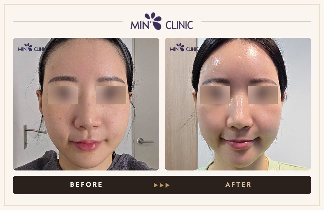 Juvelook Skin before and after, case 5 – MIN Clinic Seoul