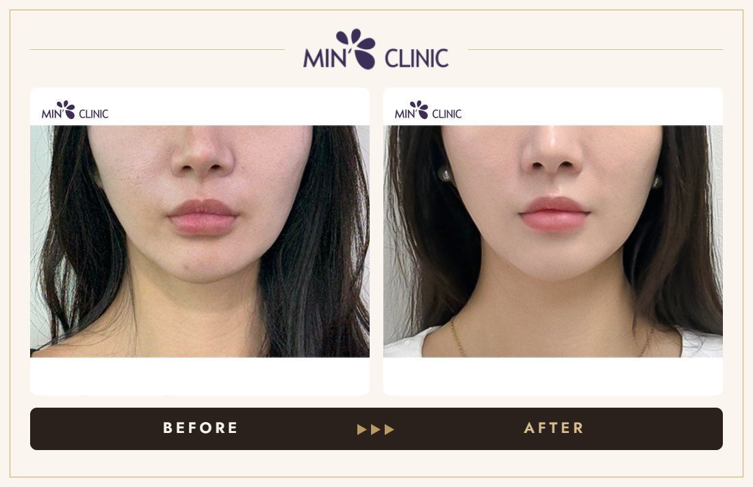 Juvelook Skin before and after, case 6 – MIN Clinic Seoul
