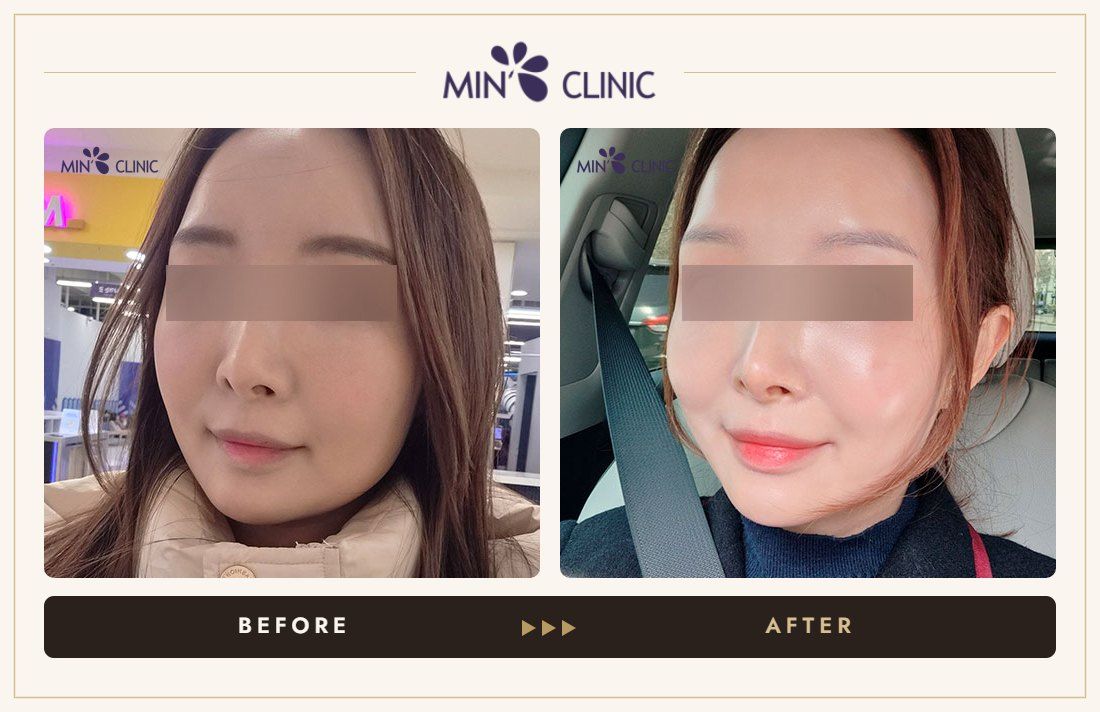 Juvelook Skin before and after, case 7 – MIN Clinic Seoul