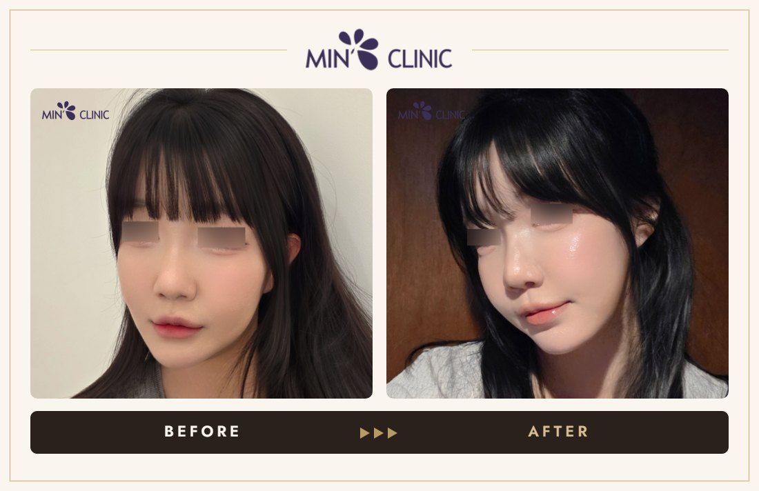 Juvelook Skin before and after, case 8 – MIN Clinic Seoul